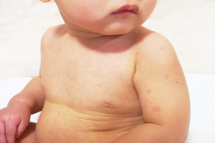 乳児湿疹の種類 細かく分けると11種類も それぞれの原因 主な症状は Papa Mama Baby